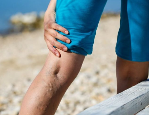 Las venas varicosas en los pies